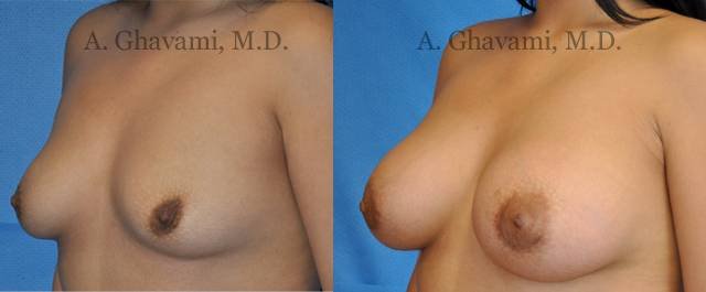 Recovery Time After Breast Augmentation 22