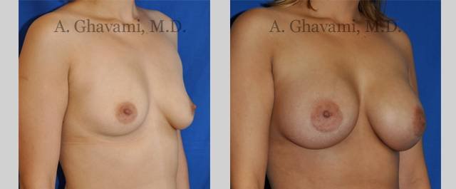Recovery Time After Breast Augmentation 81