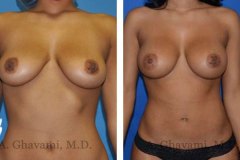 breast-augmentation-p5-001