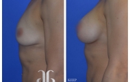 Breast-Augmentation-p36-01