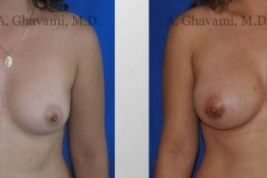 breast-augmentation-beverly-hills-1
