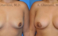 quick-recovery-breast-augmentation-beverly-hills_1