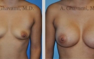 quick-recovery-breast-augmentation-beverly-hills_5