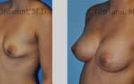 quick-recovery-breast-augmentation-beverly-hills_6