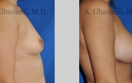 quick-recovery-breast-augmentation-beverly-hills_10