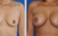 quick-recovery-breast-augmentation-beverly-hills_8