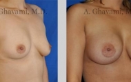quick-recovery-breast-augmentation-beverly-hills_9