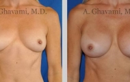 quick-recovery-breast-augmentation-beverly-hills_11