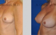 quick-recovery-breast-augmentation-beverly-hills_13