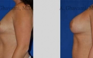 quick-recovery-breast-augmentation-beverly-hills_2
