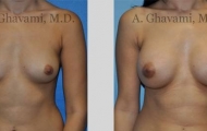 quick-recovery-breast-augmentation-beverly-hills_1