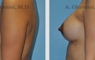 breast-augmentation-beverly-hills-2