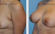 breast-augmentation-beverly-hills-3