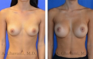 breast-augmentation-p4-001