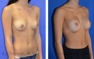 breast-augmentation-p4-002
