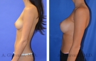 breast-augmentation-p4-003