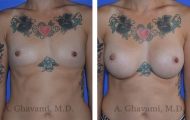 breast-augmentation-p3-001