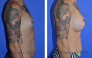 breast-augmentation-p3-003