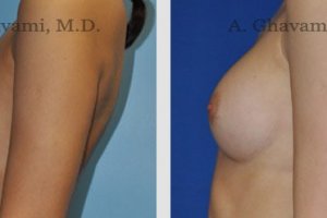 breast-augmentation-beverly-hills-2