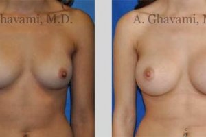 quick-recovery-breast-augmentation-beverly-hills_14