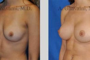 quick-recovery-breast-augmentation-beverly-hills_15