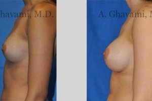 quick-recovery-breast-augmentation-beverly-hills_16