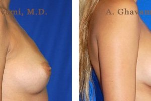 breast-augmentation-beverly-hills-1