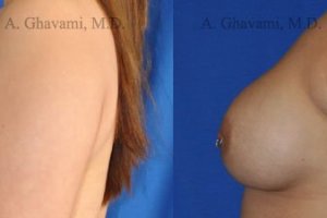 breast-augmentation-beverly-hills26