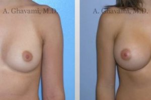 breast-augmentation-beverly-hills-3