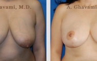 breast-reduction-beverly-hills-1