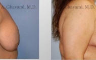 breast-reduction-beverly-hills-2