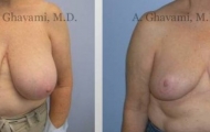 breast-reduction-beverly-hills-1