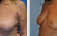breast-reduction-beverly-hills-2