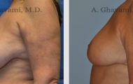 breast-reduction-beverly-hills-3