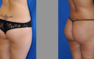 buttock-augmentation-beverly-hills-1