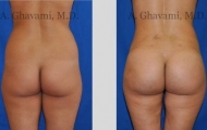 buttock-augmentation-beverly-hills-1