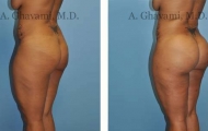 buttock-augmentation-beverly-hills-2