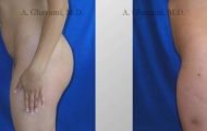 buttock-augmentation-beverly-hills-3