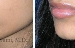 lip-augmentation-beverly-hills-2