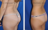 liposuction-beverly-hills-2