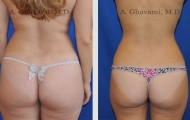 liposuction-beverly-hills-3