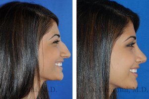 rhinoplasty-nose-beverly-hills-4