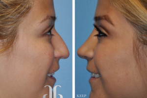 rhinoplasty-nose-beverly-hills-5