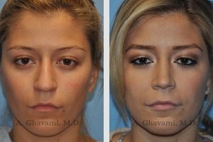 good nose job before and after