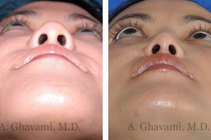 rhinoplasty-nose-beverly-hills-4