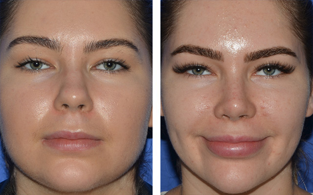 Buccal Fat Pad Removal - Ghavami Plastic Surgery