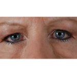 Browlift Before & After Patient #7770