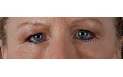 Browlift Before & After Patient #7770