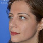 Rhinoplasty Before & After Patient #6858