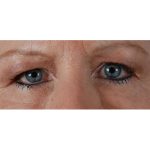 Blepharoplasty Before & After Patient #8090